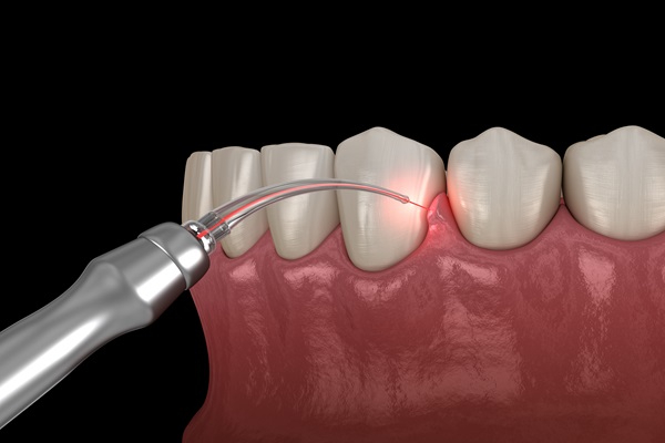 Gum Diseases & Periodontal Treatment